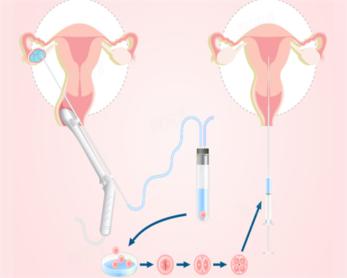 45岁天津妈妈试管过程&供卵5次不成功,看清宫表真的准吗？